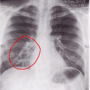 Reversing Copd Naturally - Bronchitis Infiammation