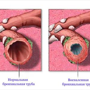 What Is Good For Bronchitis - Soothe The Body With Marshmallow Root Herb