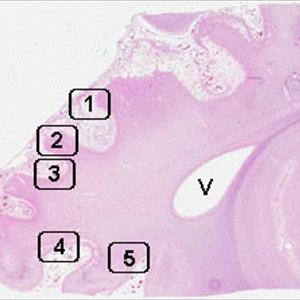 Cure For Chronic Bronchitis - Brochitis Disease