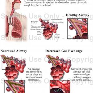 Natural Ingredients For Lungs - How In Order To Treatment Bronchitis