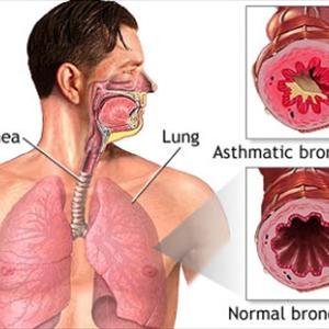 Tracheal Bronchitis - Symptoms Of Bronchitis In Newborns