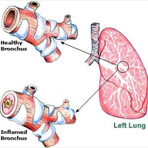 Antibiotic For Bronchitis - Dealing With Lung Related Issues