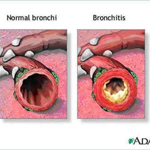 Bronchitis Drugs List - How Is Bronchitis Treated?