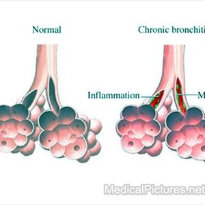 Allergies - Alternative Emphysema Treatment