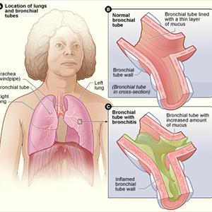 A Cure For Chronic Bronchitis - Home Remedy For Bronchitis