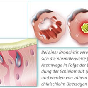 Chronic Mycoplasma Bronchitis - Infectious Bronchitis