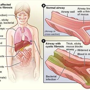 Bronchiolitis - Is Bronchitis Contagious? Yes Or No