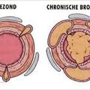 Bronchitis-Medicine - Exercise Benefits To Overcome Dyspnoea For COPD Sufferers