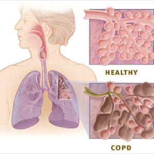 Bronoville-Bronchitis Remedy - Chronic Bronchitis: