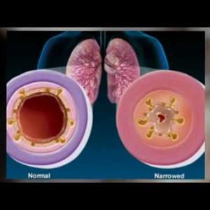 Bronchitis Lasts Forever - Bronchitis Diagnosis