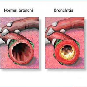 Trachial Bronchitis - Using NLP In Order To Conquer COPD