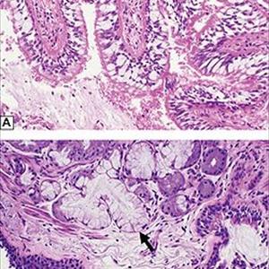 Pain In Right Bronchial Tube - Do You Enjoy Seasonal Asthma? Allergies?