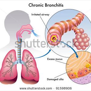 Incessant Coughing - Bronchitis Herbal